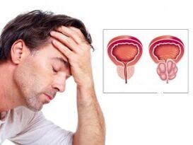 a krónikus prosztatitis jelei a férfiakban kiszámolják